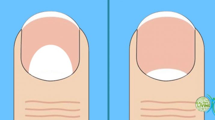 The Moons on Your Nails Can Indicate These 13 Health Problems