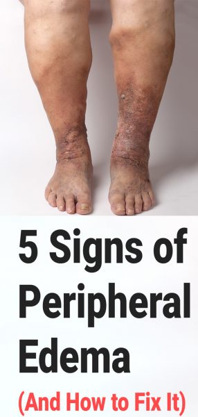 5 Signs of Peripheral Edema (And How to Fix It)